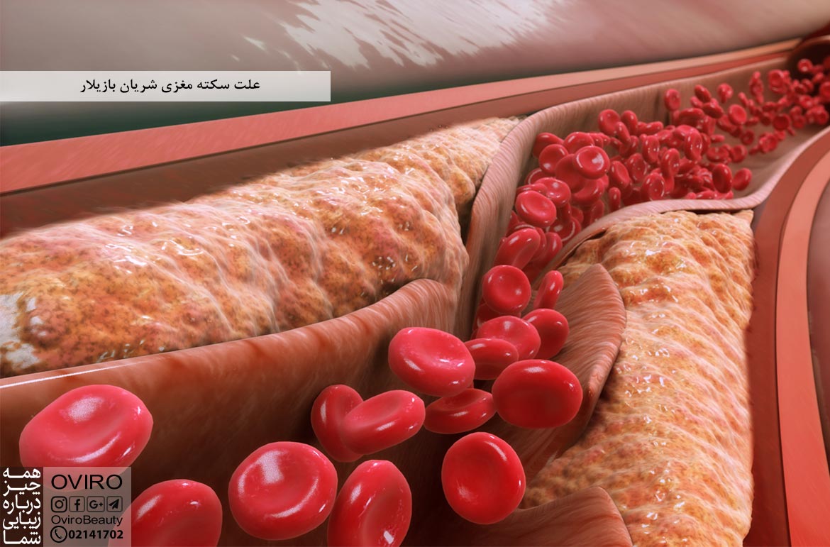 علت سکته مغزی شریان بازیلار : علائم - عوارض - تشخیص - درمان