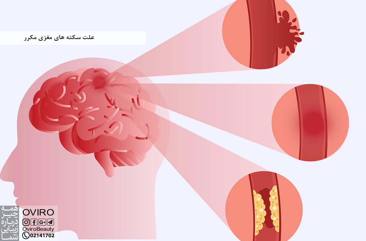 علت سکته های مغزی مکرر : علائم - تشخیص - درمان - پیشگیری - چشم انداز