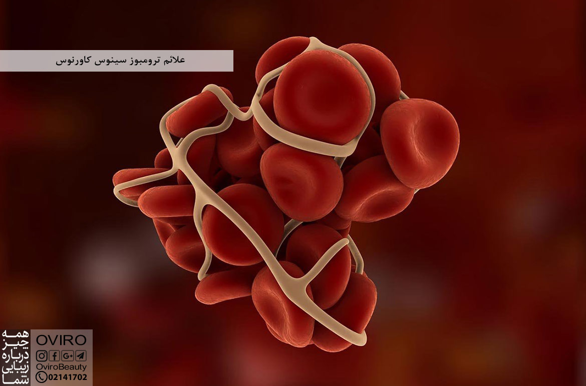 علائم ترومبوز سینوس کاورنوس : علت - تشخیص - عوارض - درمان
