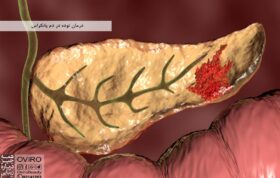 درمان توده در دم پانکراس : علائم - علت - تشخیص - طول عمر بیماران