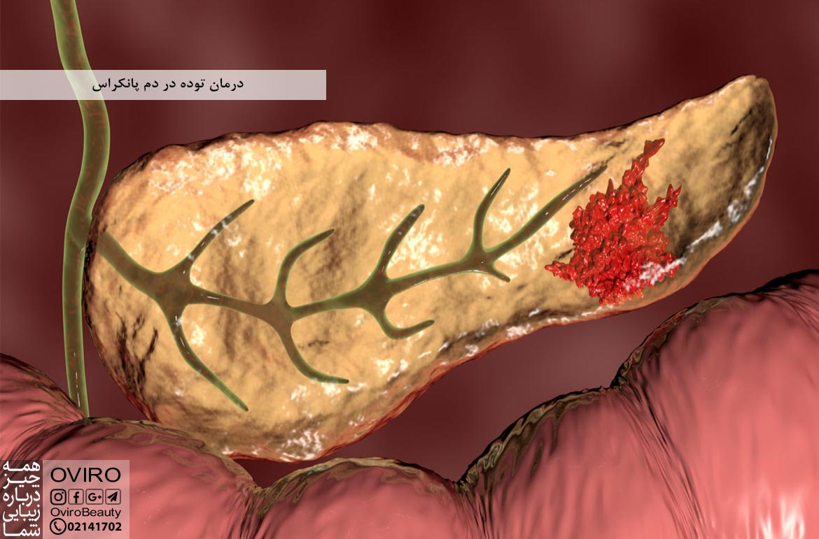 درمان توده در دم پانکراس : علائم - علت - تشخیص - طول عمر بیماران