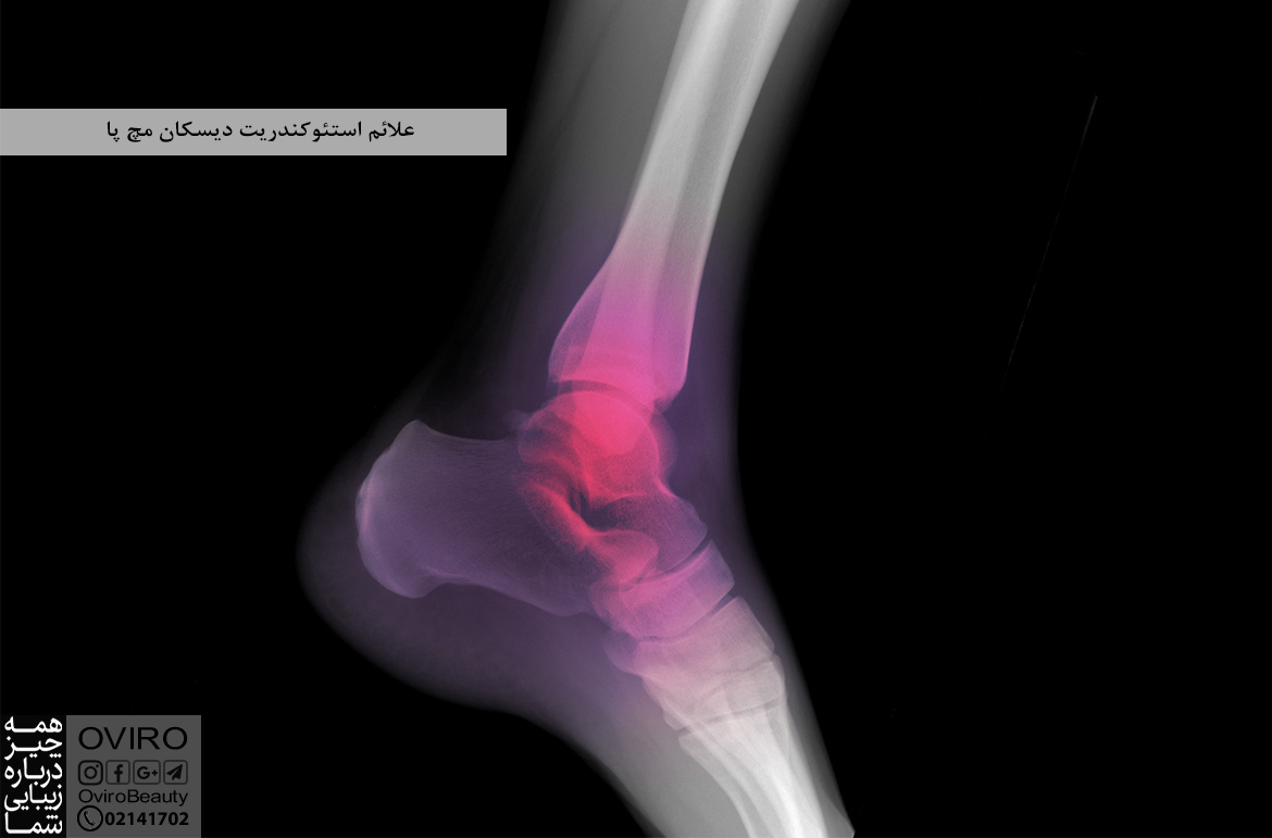 علائم استئوکندریت دیسکان مچ پا : علت - تشخیص - درمان | اویرو مگ