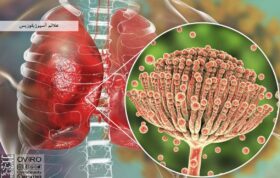 علائم آسپرژیلوزیس : علت - تشخیص و درمان قارچ آسپرژیلوس در انسان