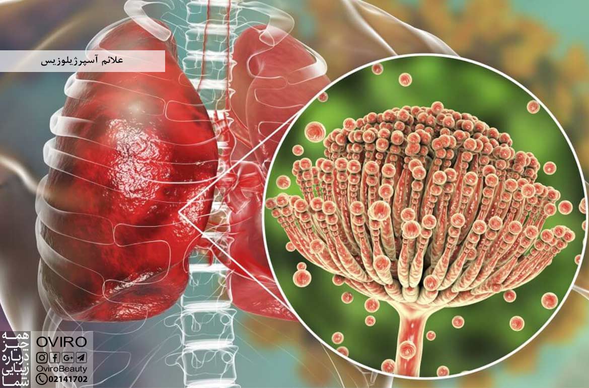 علائم آسپرژیلوزیس : علت - تشخیص و درمان قارچ آسپرژیلوس در انسان