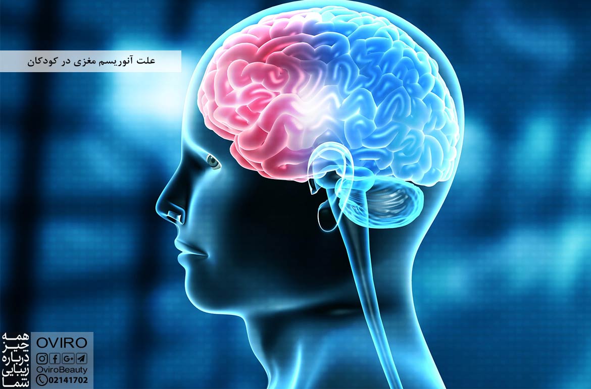علت آنوریسم مغزی در کودکان : علائم - تشخیص - درمان | اویرو مگ