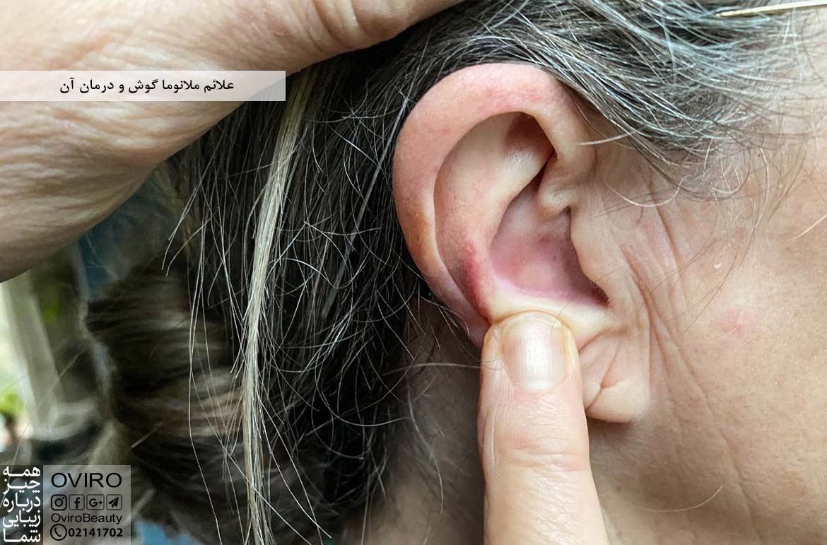 علائم ملانوما گوش : علت - تشخیص - درمان | اویرو مگ